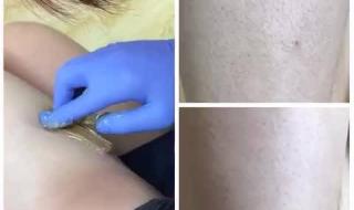 永久脱毛多少钱 永久脱毛多少钱