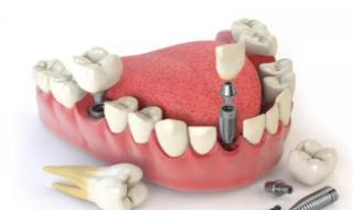 种植多少钱一颗 种植多少钱一颗